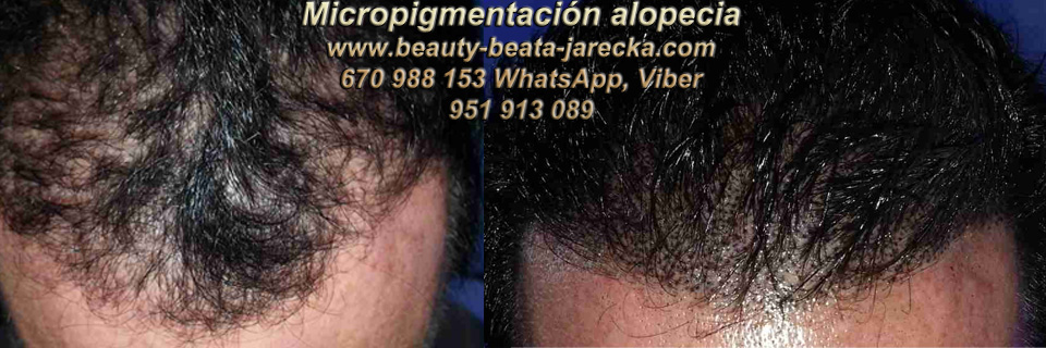 MICROPIGMENTACIÓN CAPILAR MARBELLA y MÁLAGA