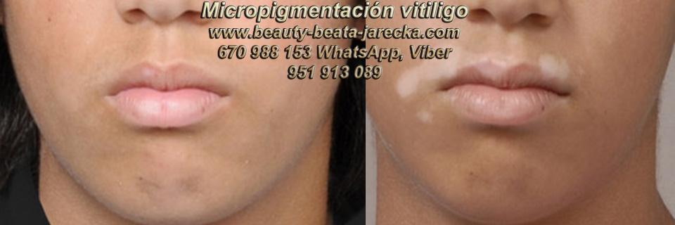 vitiligo tratamiento en MARBELLA Y MÁLAGA