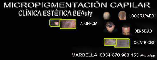 MICROPIGMENTACIÓN CAPILAR MÁLAGA